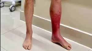 Veja foto da perna de Bolsonaro, que está internado por erisipela