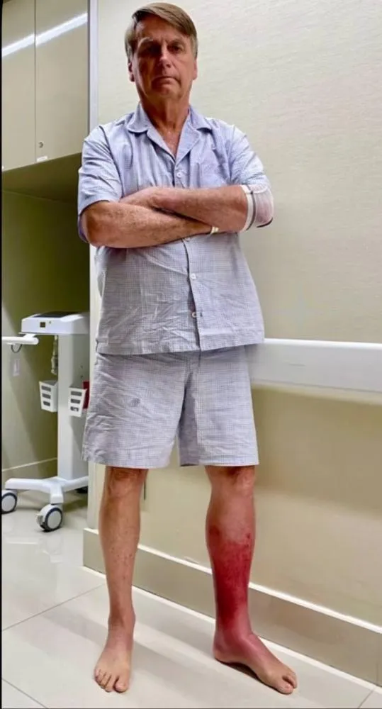 Jair Bolsonaro compartilha imagem de lesão causada por erisipela