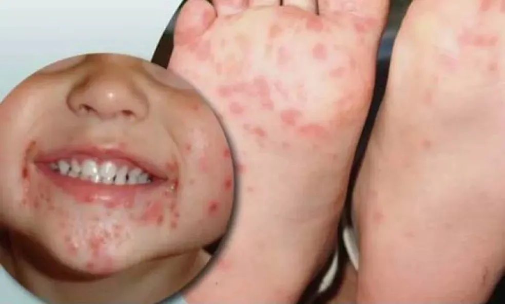 Dia D da Campanha ‘Mão-Pé-Boca’ promove educação lúdica em 39 municípios de MS