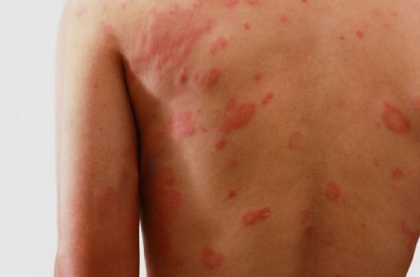 Ministério da saúde distribui 150 mil testes de Hanseníase