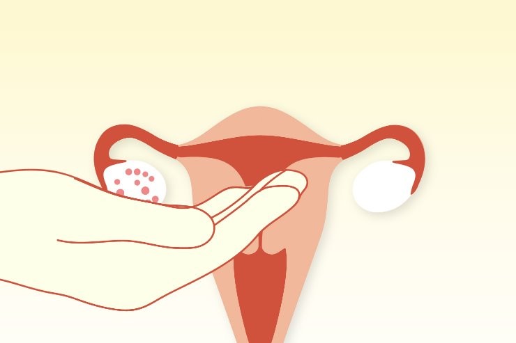 Semana de Conscientização alerta mulheres sobre a Síndrome do Ovário Policístico